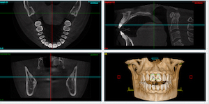 Cone beam CT