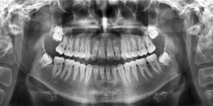 Panoramic x-ray